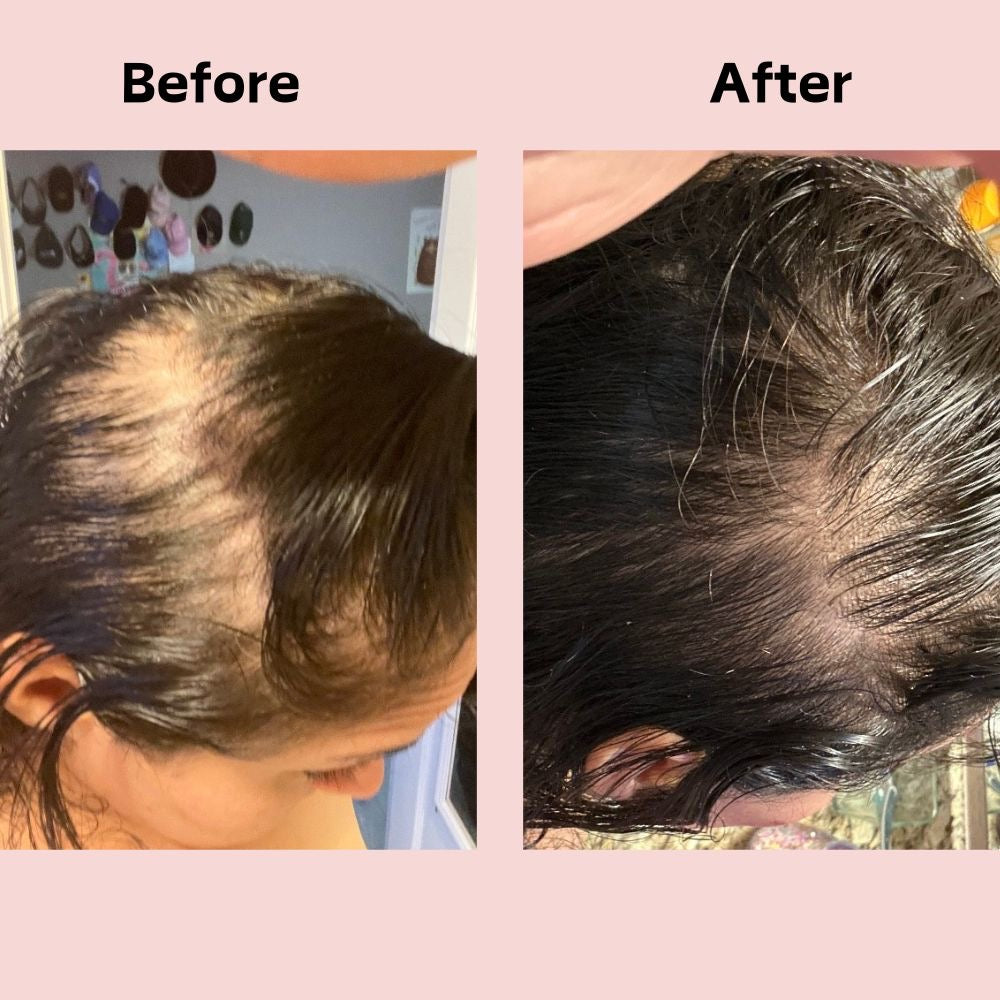 Fast Hair Growth Treatment