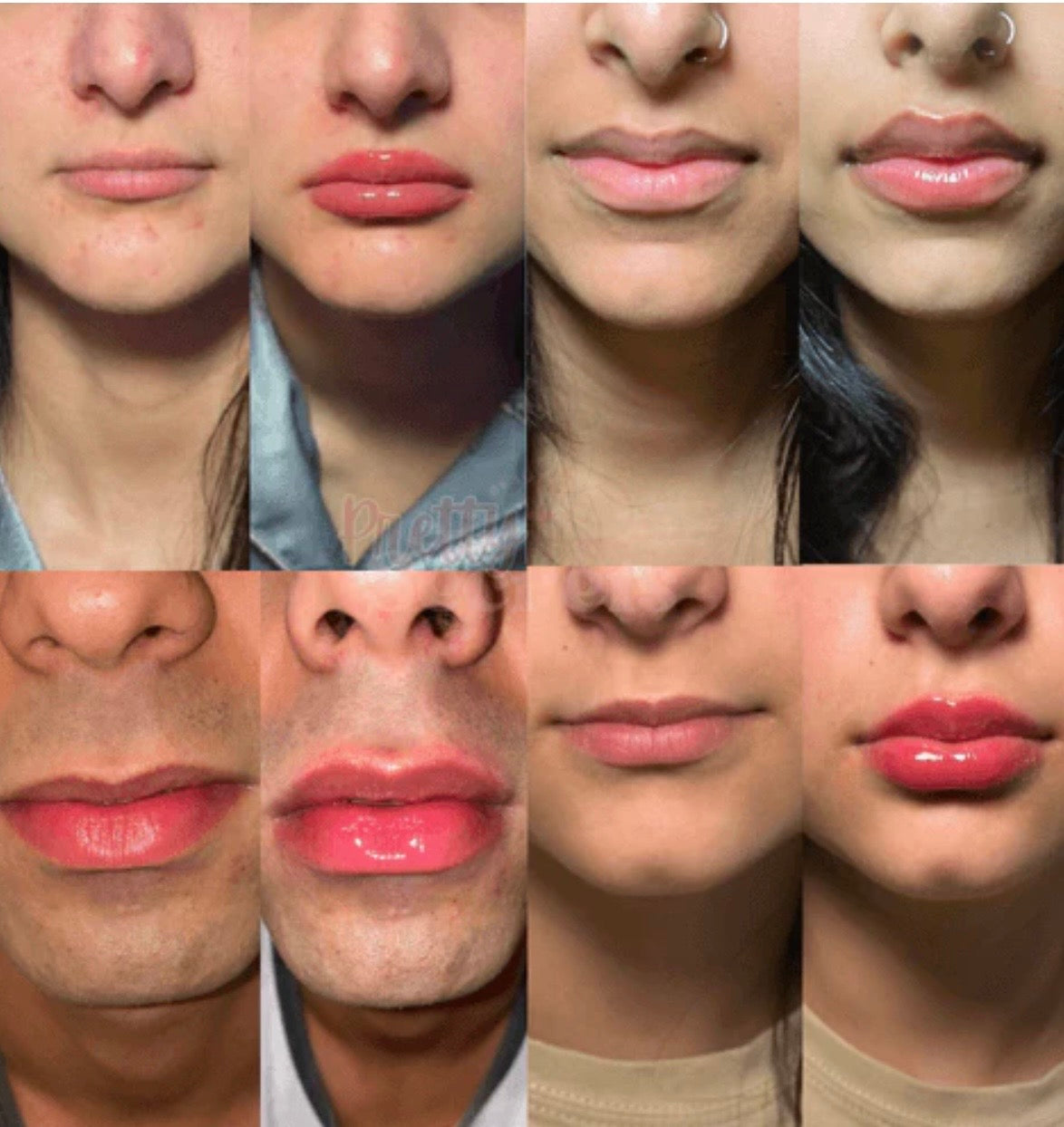 Infinite Beautye - Lip Plumper